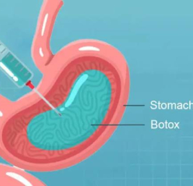 بوتاکس معده توسط دکتر محبوب کرداری متخصص گوارش